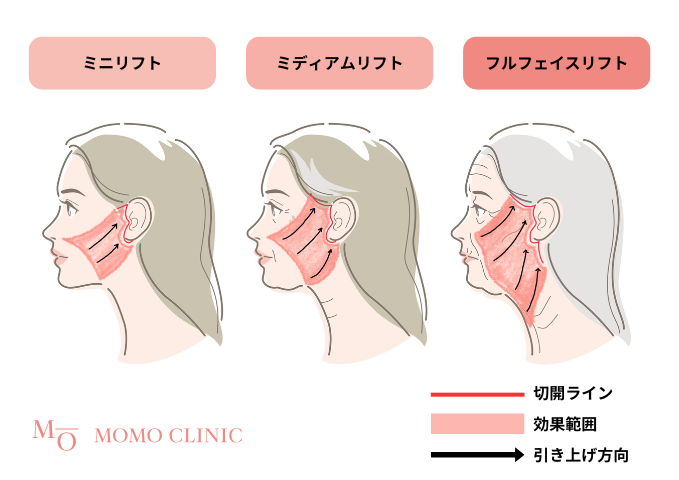 リフトアップ比較図解
