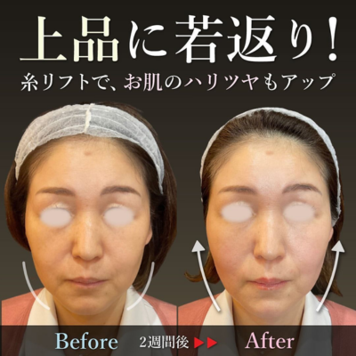 糸リフト