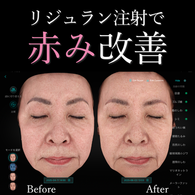 リジュランEveV画像