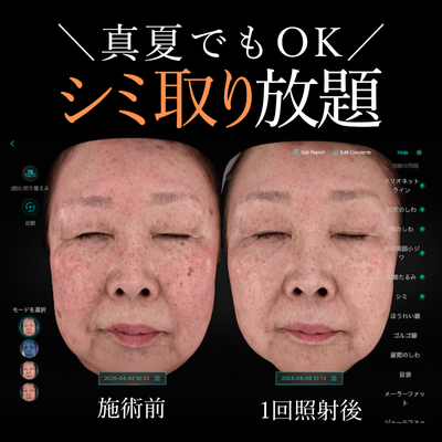 シミ治療EveV画像