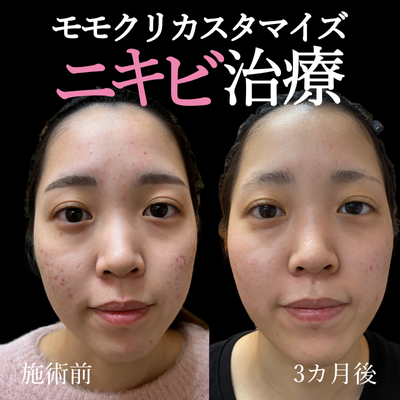 ニキビ治療画像