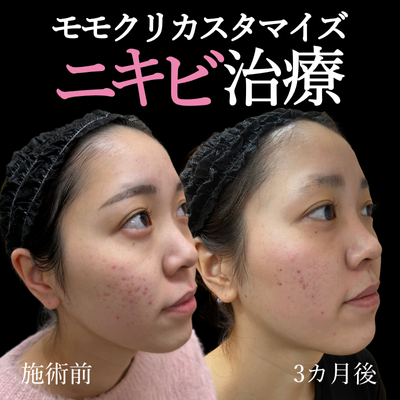 ニキビ治療画像
