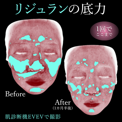 リジュラン症例