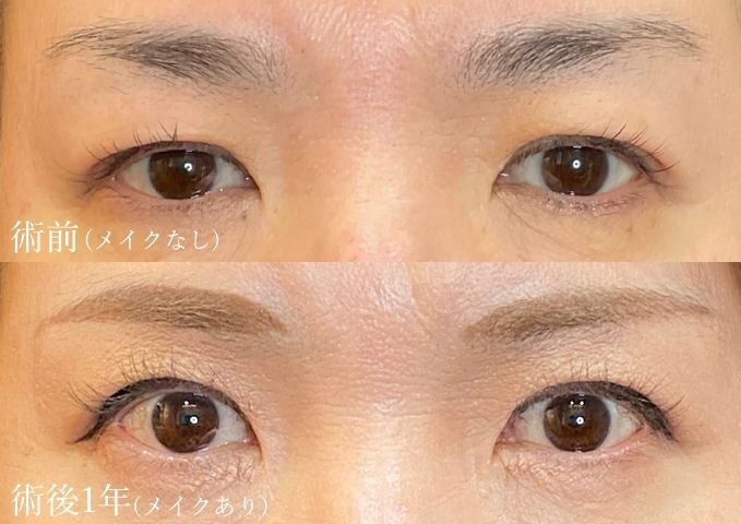 眉下切開60代症例