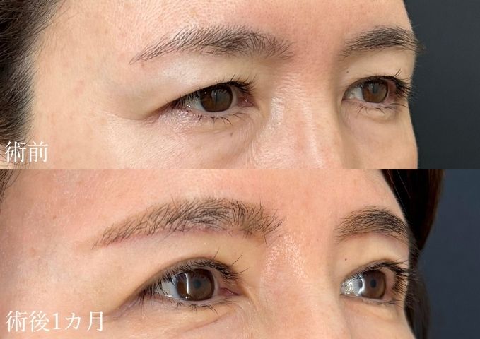 眉下切開50代症例