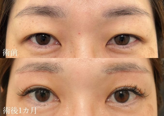 眉下切開40代症例