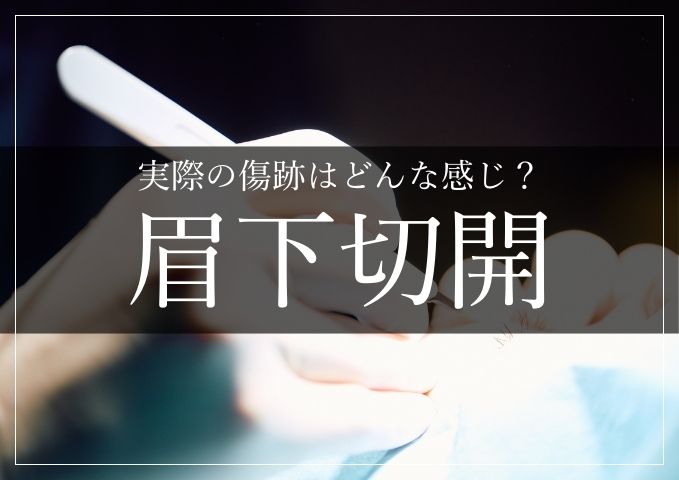 眉下切開