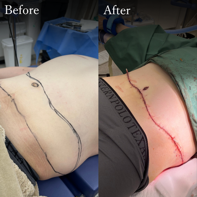 腹部リダクション お腹のたるみ取り