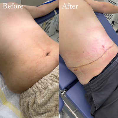 腹部リダクション