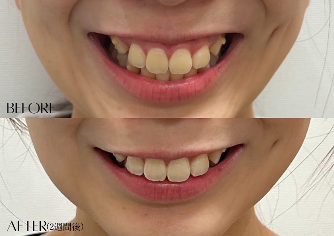 ガミースマイルボトックス