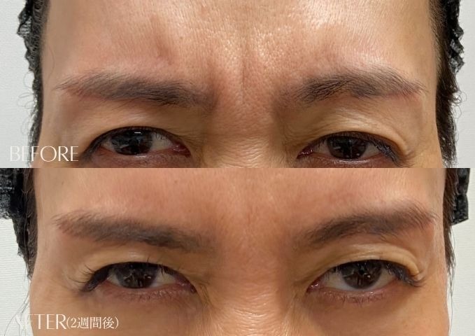 眉間のシワ改善症例