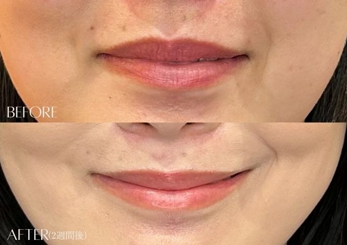 口角ボトックス症例