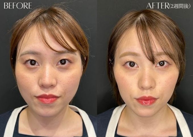 エラボトックス小顔症例