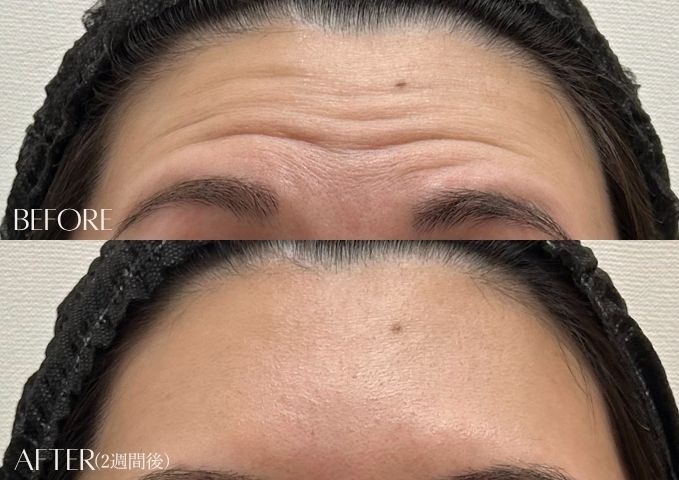 おでこのシワ改善症例