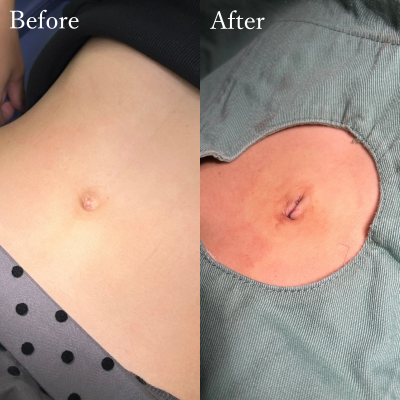 へそ形成（でべそ形成）