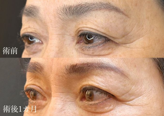 たるみ取り二重症例画像