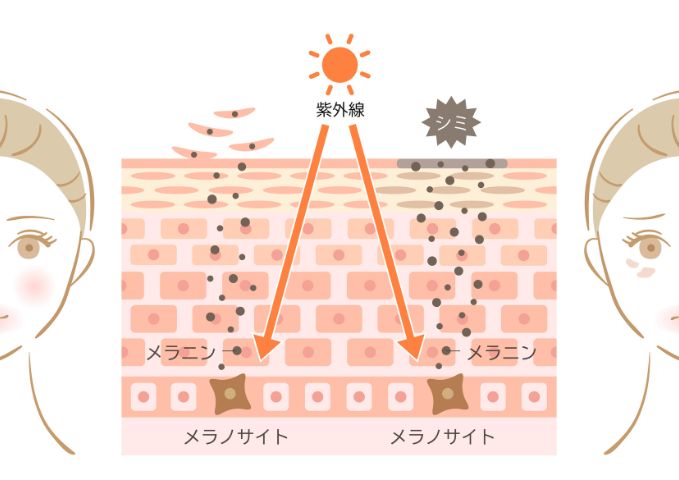 シミができるイラスト