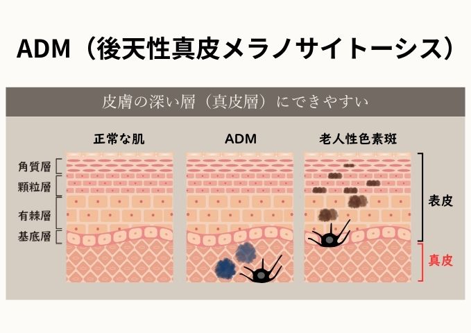 ADMの図解