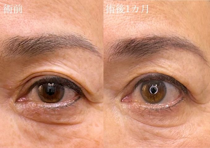 たるみ取り二重症例画像