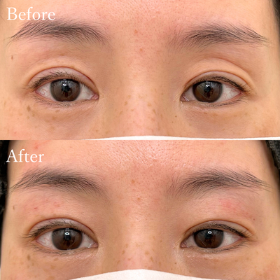 ヒアルロン酸（くぼみ目）