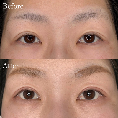 二重切開 たるみ取り二重