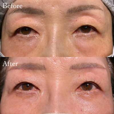 眉下切開 裏ハムラ法