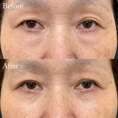 クマ取り 裏ハムラ法