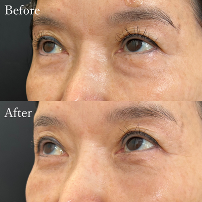 クマ取り 裏ハムラ法