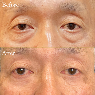 表ハムラ法（クマ取り）