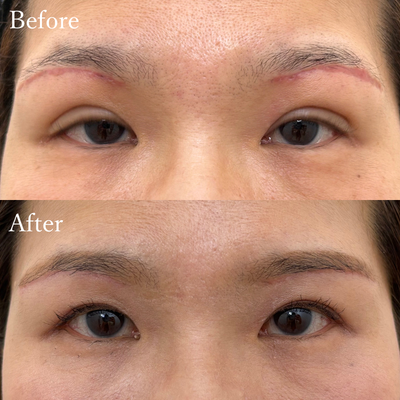 眉下切開 後遺症外来