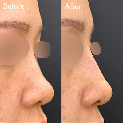 ヒアルロン酸（鼻）