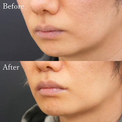 口角挙上＋人中短縮#3164