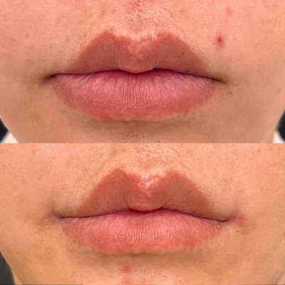 口唇縮小 下唇薄く