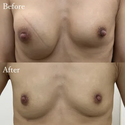 胸のヒアルロン酸除去＆乳頭縮小 後遺症外来