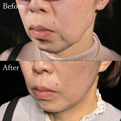 ミニリフト　フェイスリフト