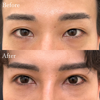 二重埋没　自然癒着法