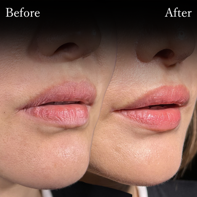 口角挙上　後遺症外来　修正