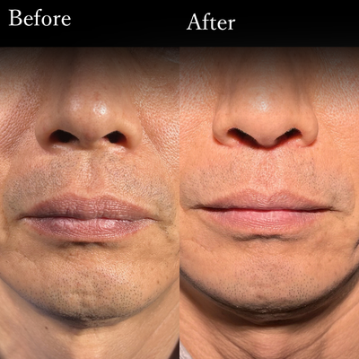 唇薄く　口唇縮小　人中短縮