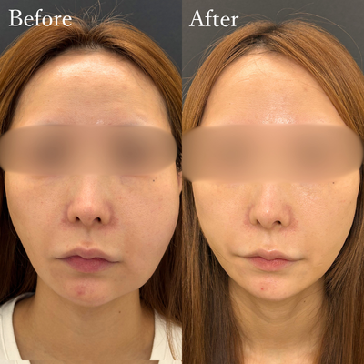 糸リフト　後遺症外来　処置