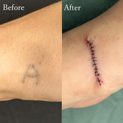 刺青切除 タトゥー除去