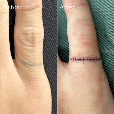 刺青切除 タトゥー除去