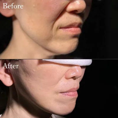 ミディアムリフト