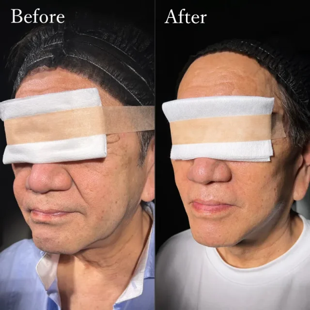 フェイスリフト(ミディアムリフト)